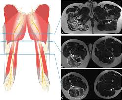 Suspended hamstring bodycurls are a great exercise to strengthen the hamstring and glutes. Widespread Venous Malformation Of The Right Thigh Infiltrating Into Download Scientific Diagram