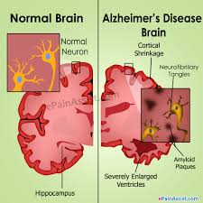 Alzheimers Disease Causes Stages Treatment Prognosis