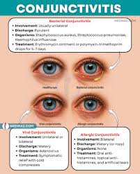 Image result for Conjunctivitis