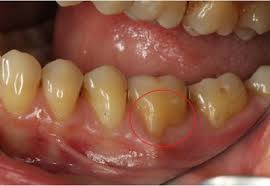It poses a problem when it compromises the appearance of your smile and increases your teeth's sensitivity to touch and temperature. Receding Gums Treatments Gum Graft Reverse Receding Gums