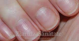 Dungi verticale pe unghie aceste dungi verticale, asemanatoare cerii scurse pe o lumanare, pot fi cauzate de mai multi factori. Boli Care Sunt Scrise Pe Unghii Ziarul De SÄnÄtate
