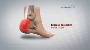 Image result for Calcaneal Apophysitis