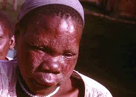 Image result for Leprosy