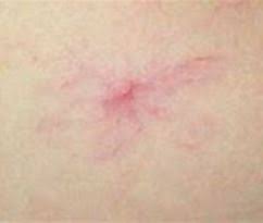 Les taches rubis sont de petits angiomes ou petites taches cutanées rondes de 2 à 9 mm de diamètre de couleur rouge violacée et qui peuvent s'établir sur n'importe quelle partie du corps. Les Angiomes Dr Isabelle Escoffier Pietri
