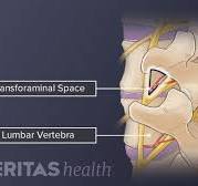 Transforaminal Lumbar Interbody Fusion (TLIF) Back Surgery