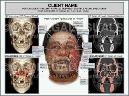 When the head is struck by a hard object the cerebral cortex (gray when the blunt object comes into contact with the bones of the human skull several reactions are possible. Facial Fracture Injuries Premier Law Group