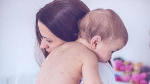 Banyak orang tua yang masih belum memahami konteks imunisasi pada bayi. Pentingnya Imunisasi Campak Untuk Anak Kapan Diberikan