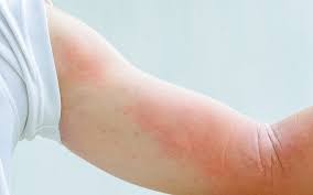Image result for dermatitis contacta allergica
