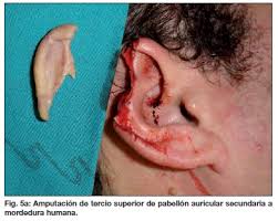 Manejo quirúrgico urgente de heridas faciales por mordedura humana