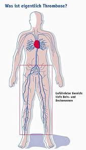 Die thrombose entspricht einer blutgerinnung, die nicht beim kontakt mit der außenwelt, sondern. Thrombose Wikipedia