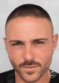 La micropigmentazione consente anche il camuffamento delle cicatrici. Tricopigmentazione Foto E Risultati Ottenuti Tricomedica