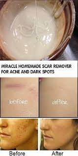 Miracle Homemade Scar Remover For Acne And Dark Spots Acne Dark Spots Scar Remedies Acne Scar Removal