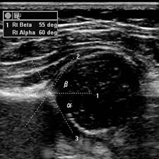 Normal Infant Hip Ultrasound Radiology Case Radiopaedia Org Ultrasound Technician Medical Ultrasound Diagnostic Medical Sonography