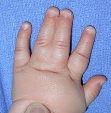 It is a birth defect with a variety of hand anomalies are other common features of poland's syndrome. 42 Poland S Syndrome Ideas Poland Syndrome Syndrome Poland