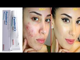 Panderm Plus Cream Review In Hindi à¤à¤® à¤² à¤ à¤« à¤¯à¤¦ Penderm Cream Ke Fayde Daag Dhabbe Ki Cream Youtube I use panderm plus cream so when i go out it makes by skin dark even i apply sunscreen i want to leave dis cream how to overcome dis problem. panderm plus cream review in hindi