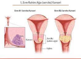 Milimetrik boyuttaki ve gözle görülemeyecek mikroskopik kanserlerin ultrasonda fark edilebilmesi imkansızdır. Rahim Agzi Kanseri Belirtileri Ve Tedavisi