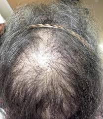 To many, hair loss is one of the more dreaded side effects of chemotherapy for cancer. Dermatologic Conditions In Women Receiving Systemic Cancer Therapy Abstract Europe Pmc