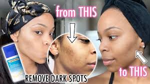 Helps reduce the risk of scarring and hyperpigmentation by treating acne. How To Get Rid Of Dark Spots On Your Face Get Clear Skin I Used Differin Gel For A Month Youtube