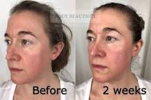 Image result for smooth beauty laser tria how long treatment