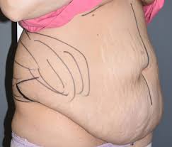 You Might Need Need A Breast Reduction Now! | Greer Plastic Surgery