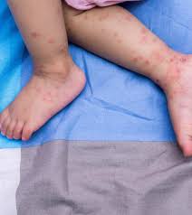 The aim is to ease symptoms and make the person as. Hand Foot And Mouth Disease In Babies Causes Symptoms And Home Remedies