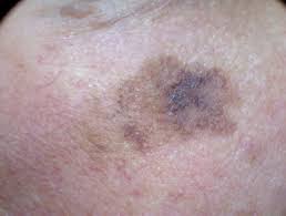 Skin cancer is the most common type of cancer in the united states by a pretty large margin, and it does not discriminate. Genetics Of Melanoma Dermnet Nz