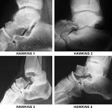 Image result for Talus Fracture