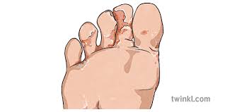 Foot definition, (in vertebrates) the terminal part of the leg, below the ankle joint, on which the a unit of length, originally derived from the length of the human foot. Athletes Foot Illustration Twinkl