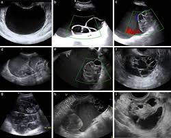 Pathology small cystic ovarian structures should be considered normal ovarian follicles unless ovarian cysts are commonly encountered in gynecological imaging, and vary widely in etiology radiographic features. Imaging In Gynecological Disease 11 Clinical And Ultrasound Features Of Mucinous Ovarian Tumors Moro 2017 Ultrasound In Obstetrics Amp Gynecology Wiley Online Library