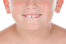 In fact, a report by the american dental association indicates that approximately 25.4 % of americans are born with a diastema. Does Your Child Have Front Teeth Gaps Smilefocus Dentist Singapore