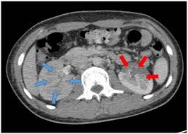 Image result for Renal Infarction
