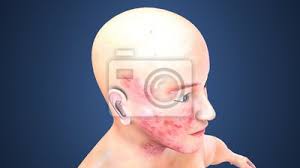 Ilustracao 3d Da Acne Na Cara Da Pele Nota Selecione O Foco Pinturas Para A Parede Quadros Saude Menina Feminino Myloview Com Br