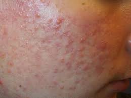 acne types in pictures explanations and treatments