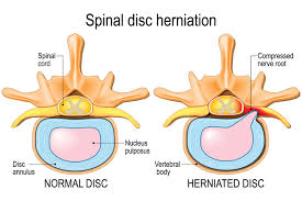 Looking for slipped disc (herniated) treatment in india? Slipped Disc Prolapsed Disc Bones Mount Elizabeth Hospitals