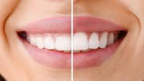 Image result for how to code for laser treatment for gum bacteria one tooth