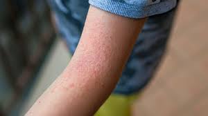 Image result for Atopic eczema atopic dermatitis