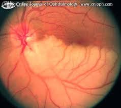 Gefaessverschluesse Im Auge Auge Online