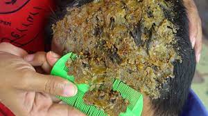 This is the largest skin flake i've had to date! Satisfying Dandruff Removal Scratching Scalp Biggest Flakes 230 Youtube
