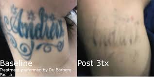 Laser technology has been used for several decades as the most effective method to eliminate tattoos. Laser Tattoo Removal Enlighten Latest And Most Effective Technology Fastest Results Hartford Ct