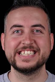 invisalignfirst #earlyintervention #clearaligners #childorthodontics  #jawdevelopment #crowdingcorrection #alignerexpert #invisalignturkey  #orthodontics #izmirorthodontist