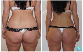Relax your eyes for a few seconds. Vaser Liposuction For Buttock Reshaping Fat Removal Hips Liposuction On Buttocks