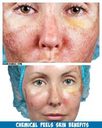 Pin On Benefits Of Chemical Peels