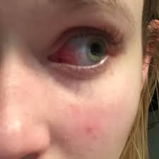 Eine wichtige rolle spielen bindehautentzündungen. Auge Juckt Und Ist Rot Frauen Krankheit Schmerzen