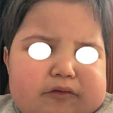 PDF) Dental Management of a Tunisian Child with Sanjad-Sakati Syndrome