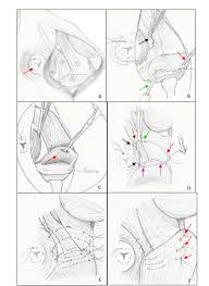 To assist communication among human rehabilitation and veterinary colleagues, some anatomic terms used. Scielo Brasil Reinforcement Of The Pelvic Diaphragm Using A Purse String Suture In Dogs Description Of Technique Reinforcement Of The Pelvic Diaphragm Using A Purse String Suture In Dogs Description Of Technique