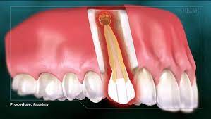 Easy root canal procedures can be done in 30 to 60 minutes, but in molars or more complicated areas, you can expect a root canal treatment to take up to 90 minutes. All About Apicoectomy Endodontics