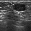 Breast cancer treatment triple negative. 3