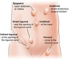 Hernia Repair Highgate Private Hospital
