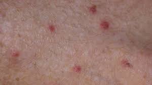 Scabies is a skin infection caused by small parasites in the skin. Scabies Vs Bed Bugs Identification And Treatment