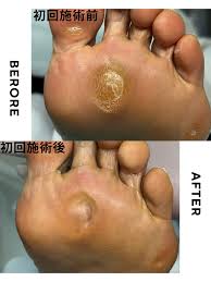 タコ魚の目]症例紹介】立つだけで痛い魚の目が改善！ | 東京巻き爪補正店